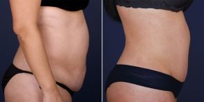 tummy-tuck-liposuction-15115c-inlandcs