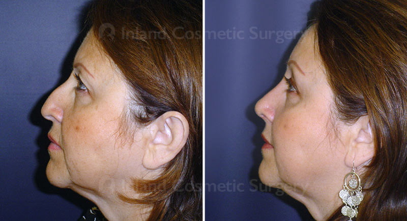 Rhinoplasty, Browlift, & Eyelid Surgery