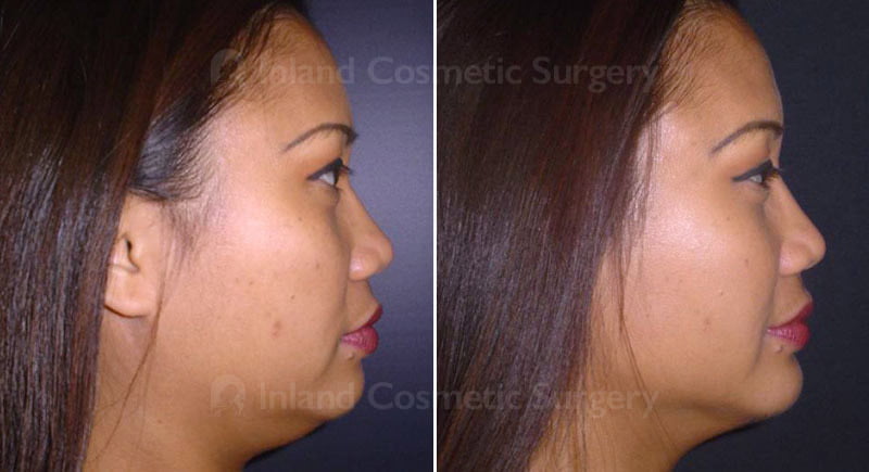 Before and after chin augmentation