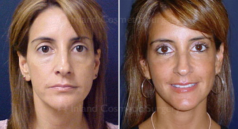 Eyelid Surgery