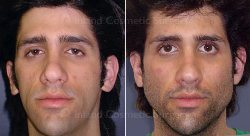 Facial Implants Patient 241