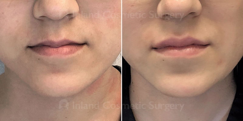 Lip Augmentation Patient