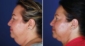neck-liposuction-15418c-left-inlandcs