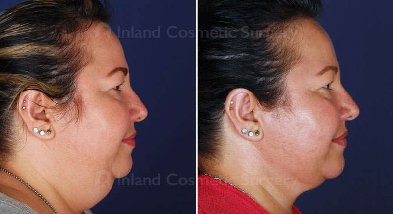 Neck Liposuction Patient