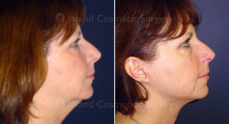 Neck Liposuction Patient 270