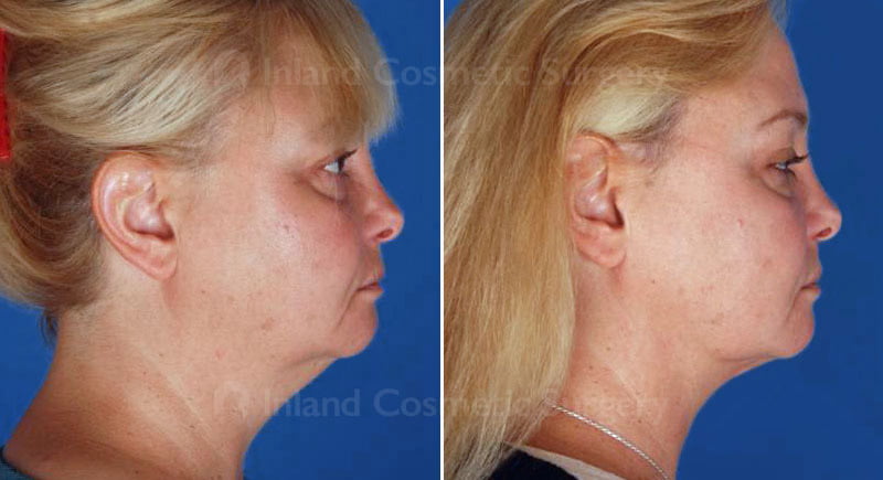 Neck Liposuction Patient 351