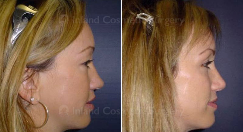 Rhinoplasty Patient 214