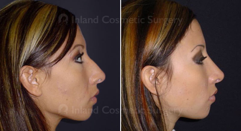 Rhinoplasty Patient 215