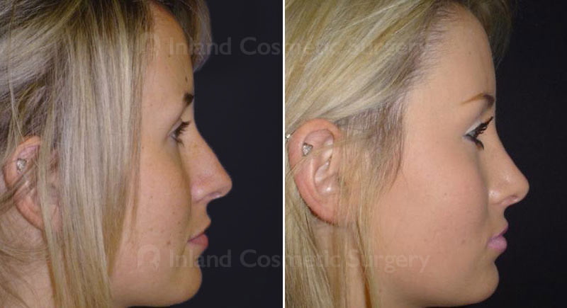 Rhinoplasty Patient 217