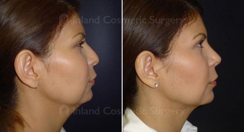 Rhinoplasty Patient 218