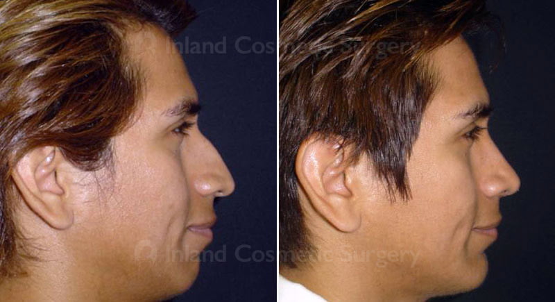 Male patient shown before and 3 months after Rhinoplasty, Septoplasty and Chin Augmentation.