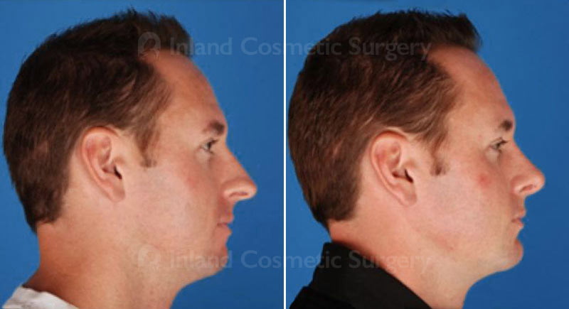 Rhinoplasty Patient 246