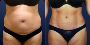 tummy-tuck-liposuction-15268a-inlandcs