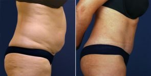 tummy-tuck-liposuction-15268c-inlandcs