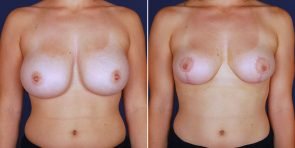 breast-reduction-15306a-inlandcs
