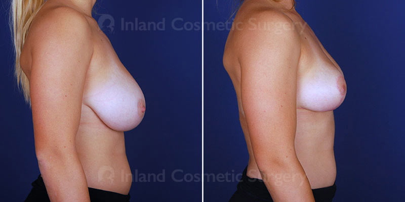 breast-reduction-15306c-inlandcs