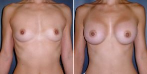 TUBA Breast Augmentation Patient