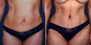 tummy-tuck-liposuction-15732a-inlandcs