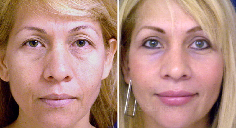 Browlift Patient