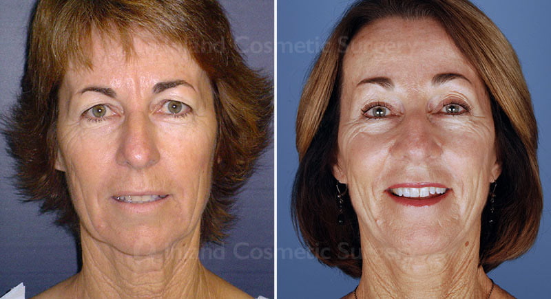 Browlift Patient