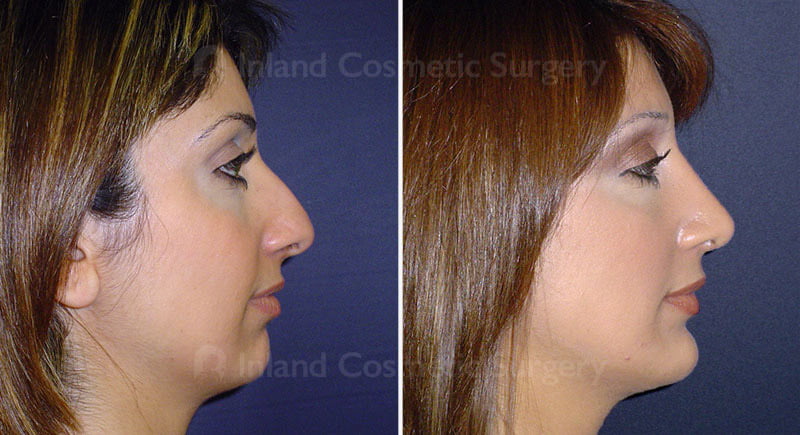 Rhinoplasty Patient