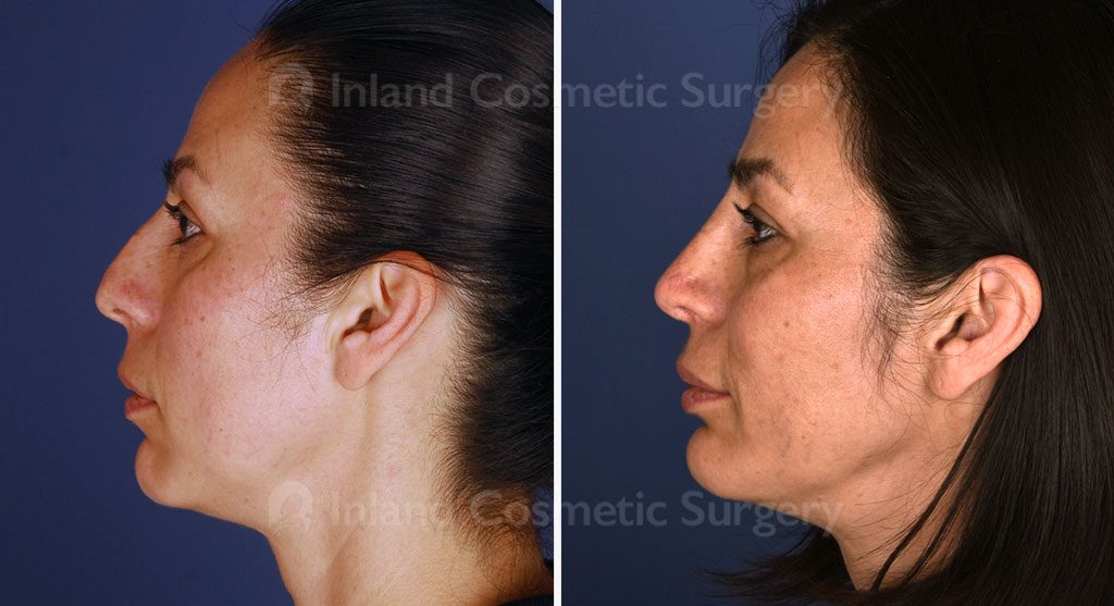 Rhinoplasty Patient