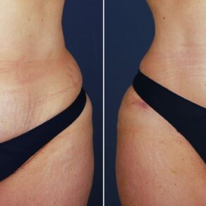 What’s the Key to a Superb, Natural-Looking Tummy Tuck? It’s All in the Belly Button.