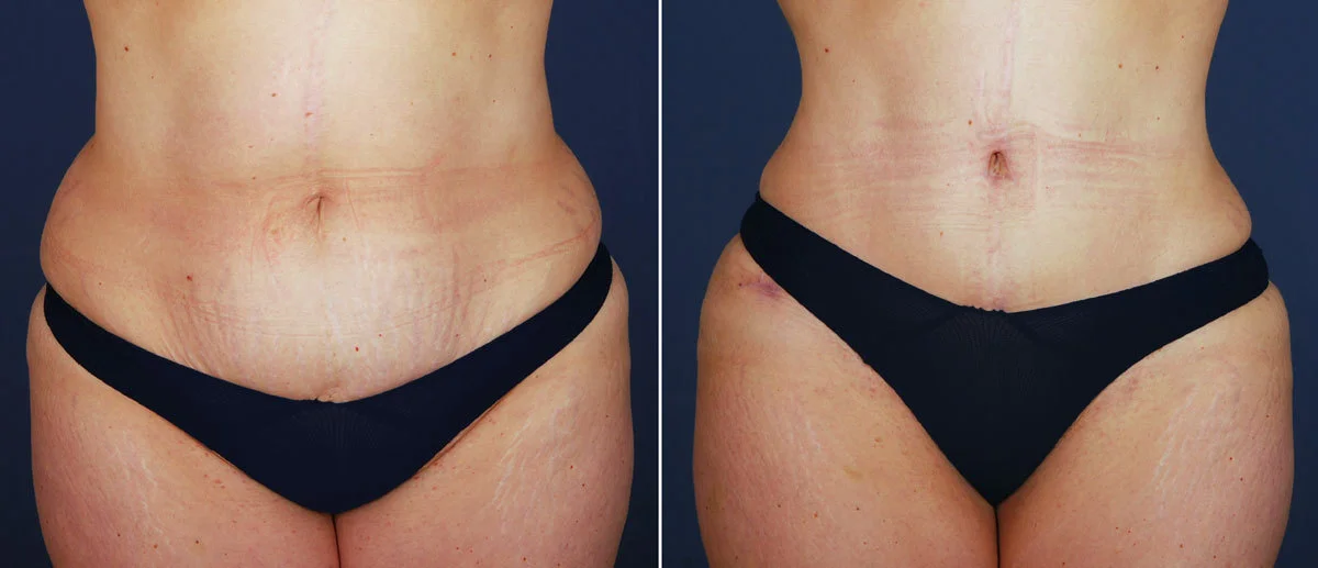 What's the Key to a Superb, Natural-Looking Tummy Tuck? It's All