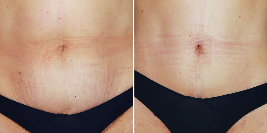What's the Key to a Superb, Natural-Looking Tummy Tuck? It's All in the  Belly Button. – Inland Cosmetic Surgery