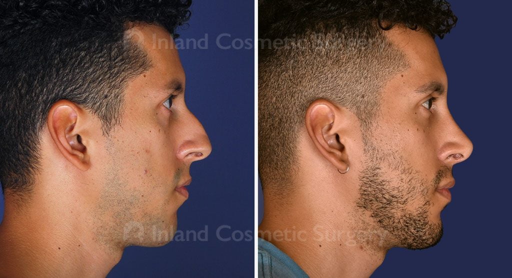 Rhinoplasty Patient