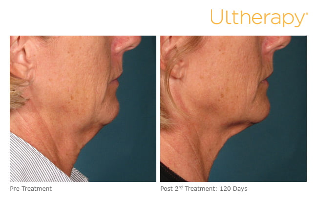 Before and after Ultherapy treatment