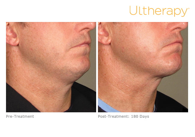 Before and after Ultherapy treatment