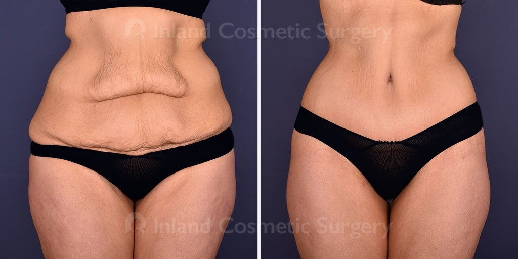 Patient before and after body lift