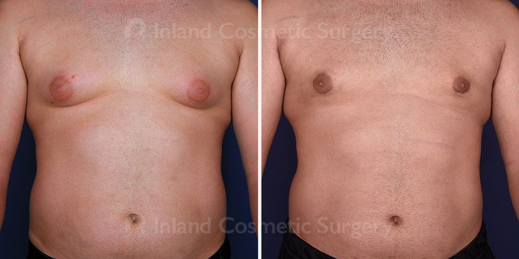 Male Breast Reduction