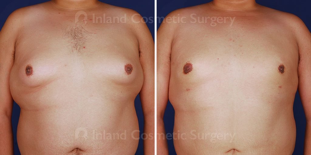 Male Breast Reduction