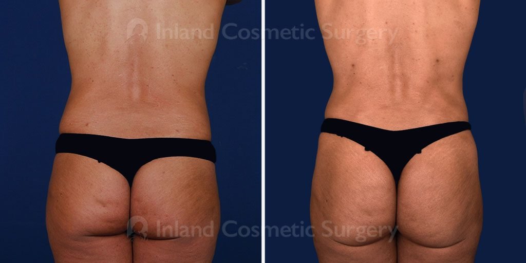 liposuction-vaser-bbl-17069d-inlandcs