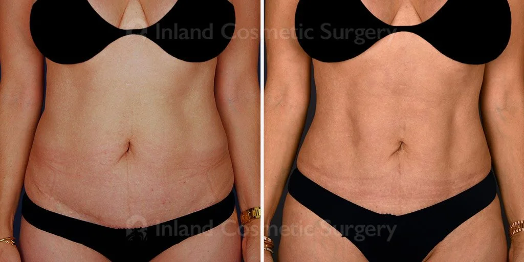 Liposuction and Brazilian Butt Lift