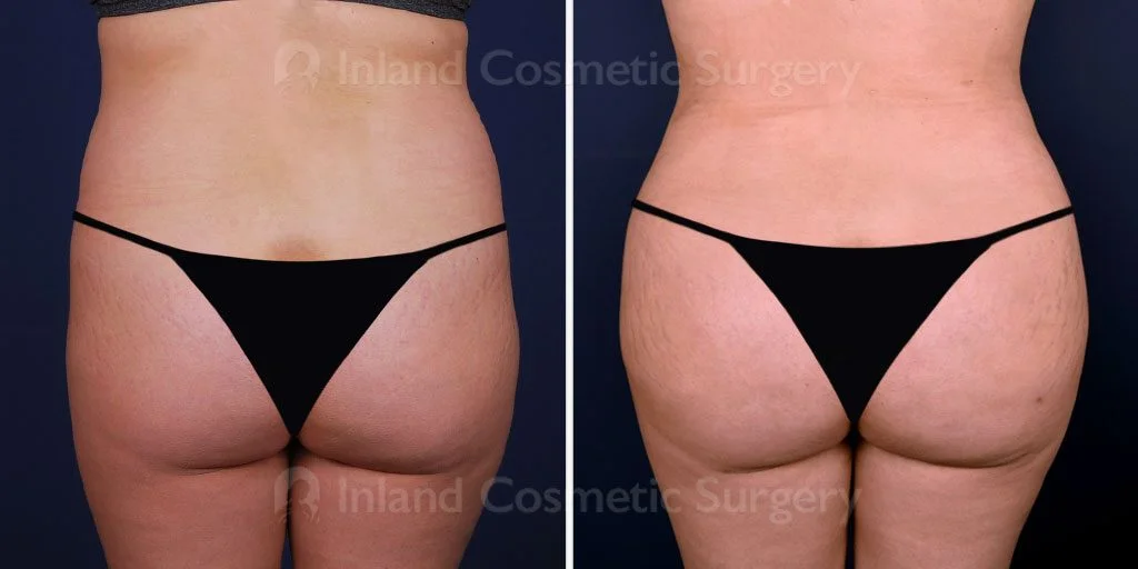 Liposuction and Brazilian Butt Lift