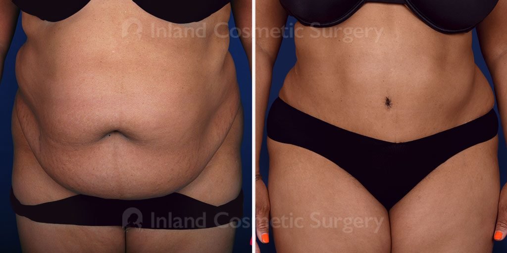 Panniculectomy with Liposuction