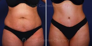 tummy-tuck-liposuction-tickle-vaser-15966a-inlandcs