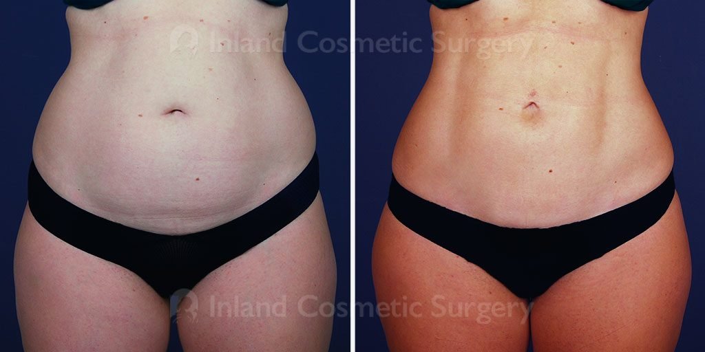Liposuction