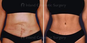 tummy-tuck-mini-liposuction-tickle-16594a-inlandcs