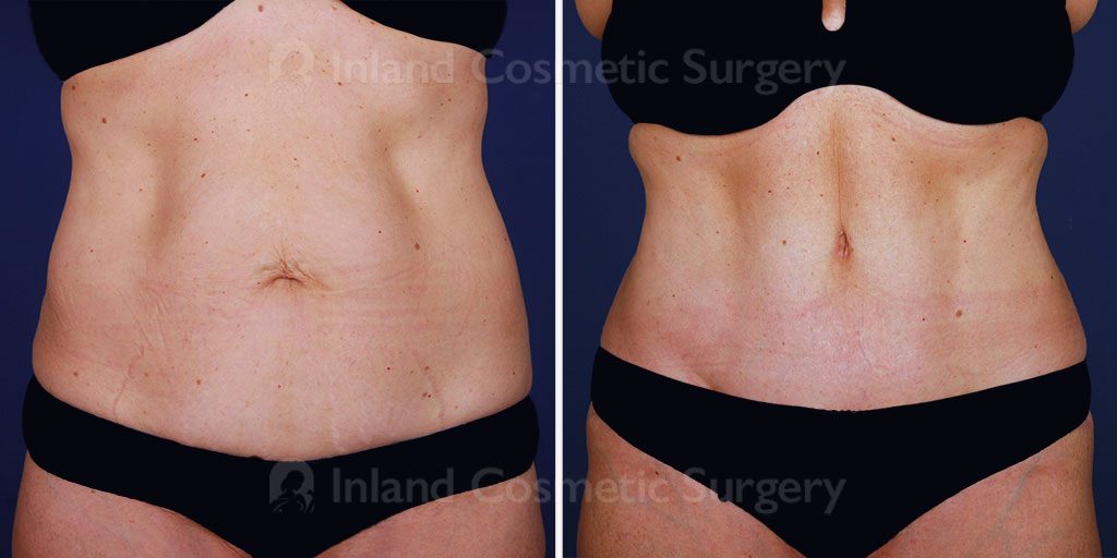 tummy-tuck-vaser-liposuction-15482a-inlandcs