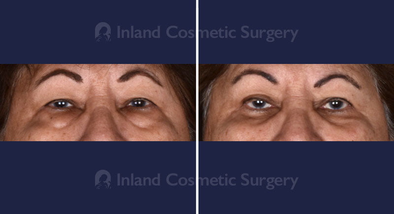 Eyelid Surgery Patient