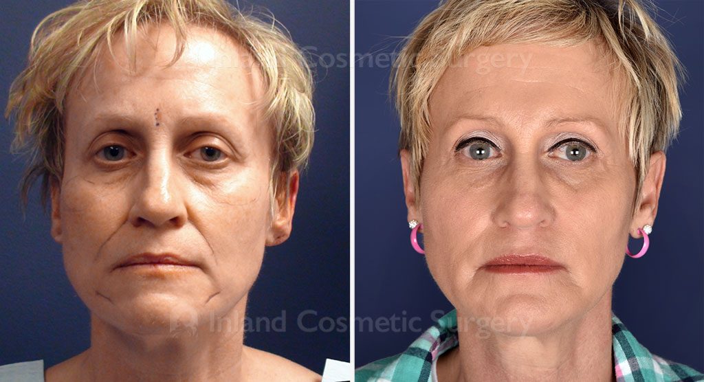 Facial Fat Transfer