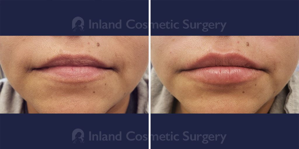 Lip Augmentation Patient