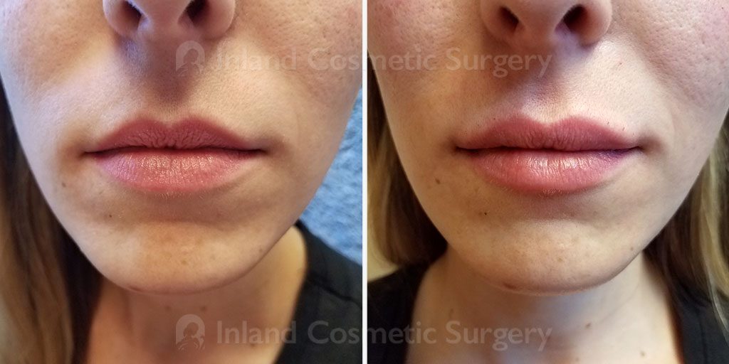 Lip Augmentation Patient