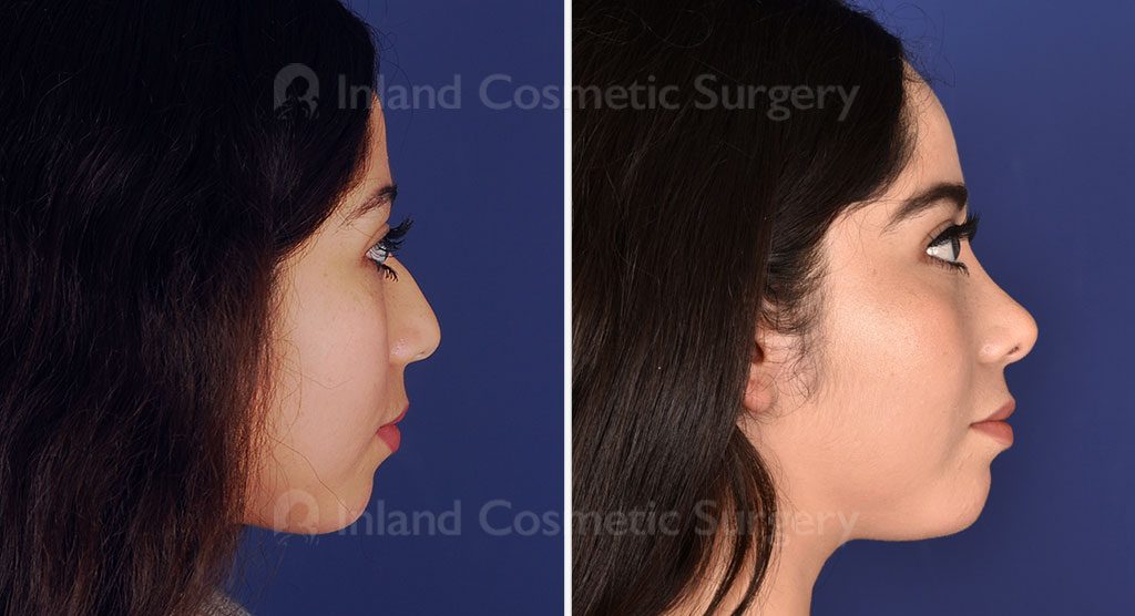 Rhinoplasty Patient