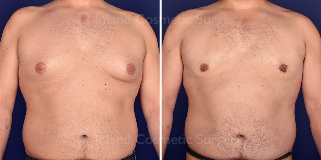 Male Breast Reduction