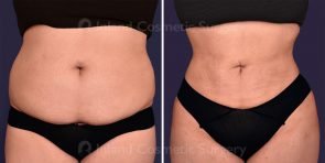 Liposuction and Fat Transfer